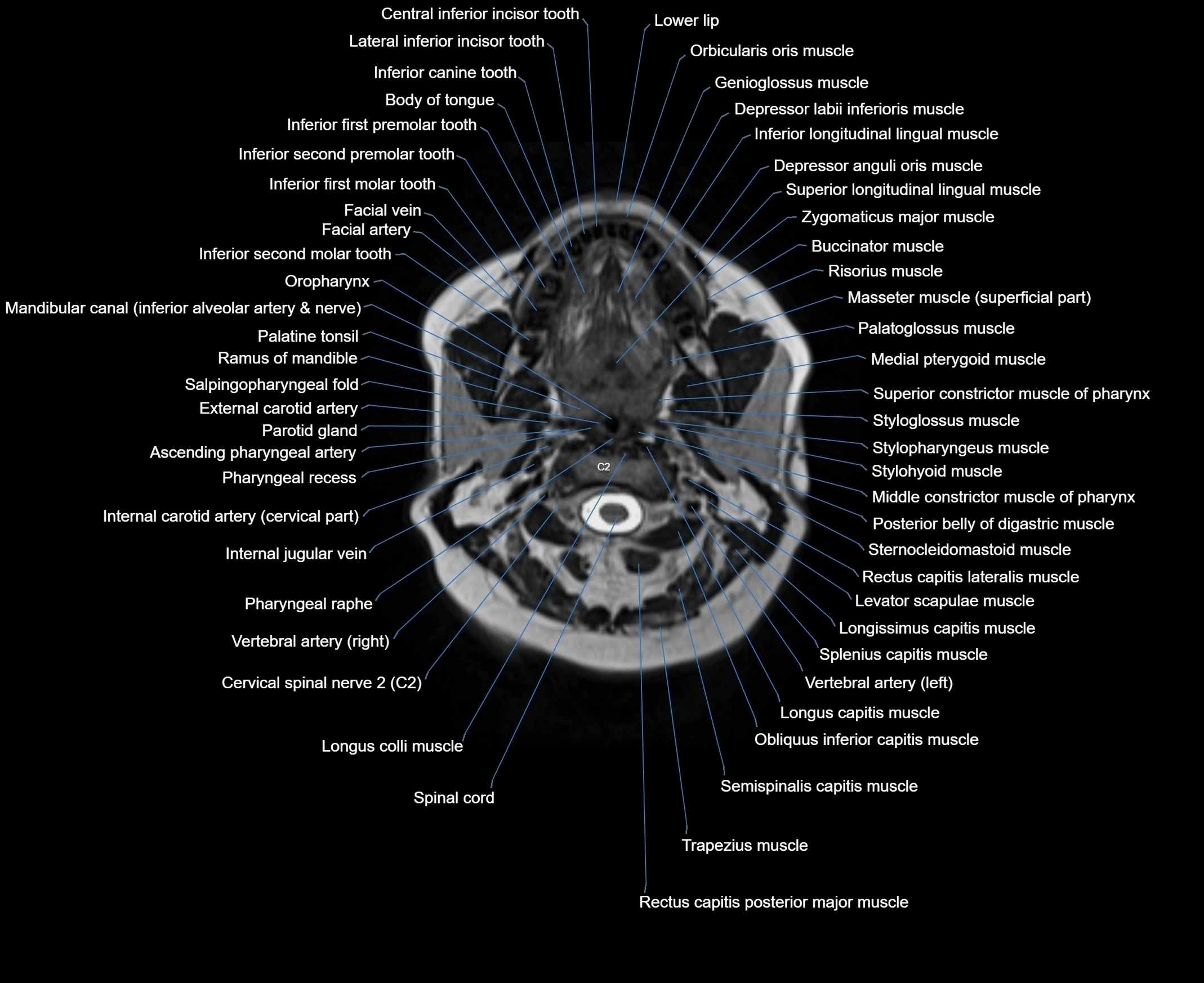 MRI Neck 3D labelled cross section anatomy axial 3t image-00001-00032.webp